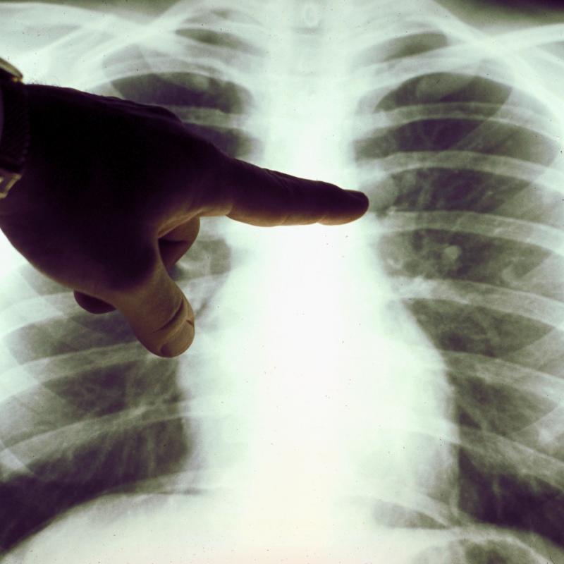 A doctor points a finger at a chest x-ray that shows the ribs